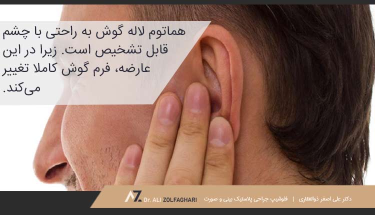 علائم هماتوم لاله گوش چیست؟
