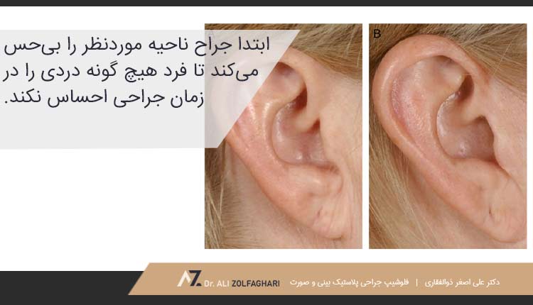 مراحل انجام جراحی نرمه گوش