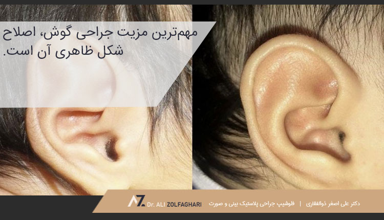 مزایای عمل اتوپلاستی گوش