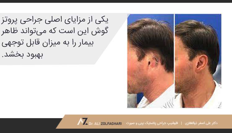 مزایای عمل پروتز گوش