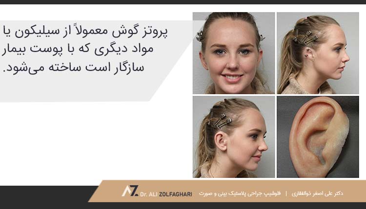 منظور از عمل پروتز گوش چیست؟