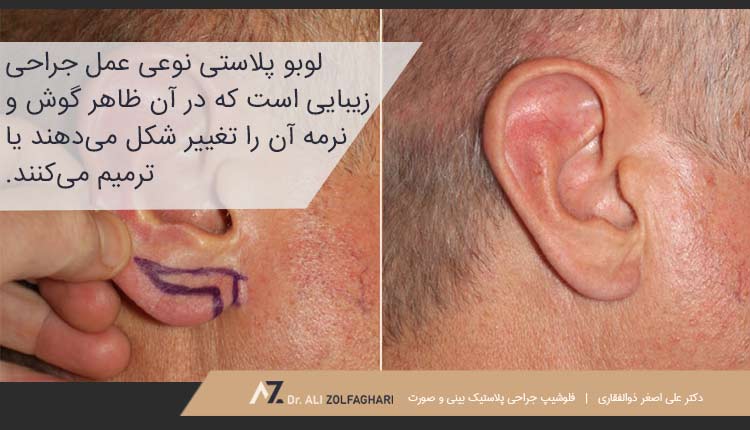 منظور از لوبو پلاستی چیست؟