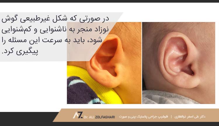 کاندیدای مناسب برای درمان بدشکلی گوش نوزاد