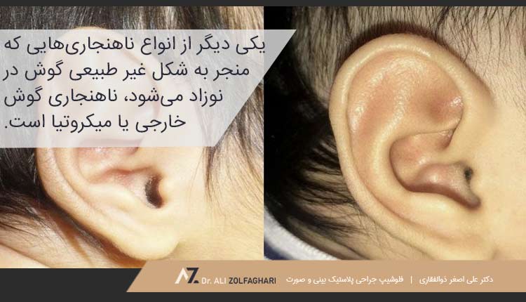 انواع تغییر شکل غیر طبیعی در نوزادان
