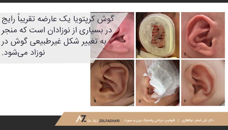 انواع تغییر شکل غیر طبیعی در نوزادان