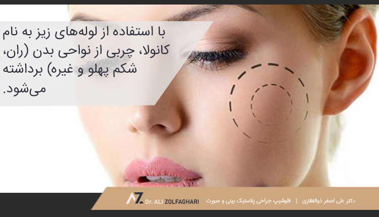 تزریق چربی به گونه چگونه انجام می‌شود؟