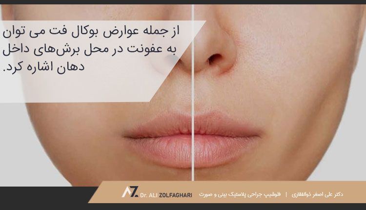 عوارض بوکال فت