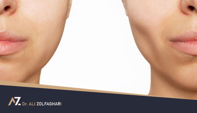 چه کسی کاندید مناسب برای عمل بوکال فت است؟