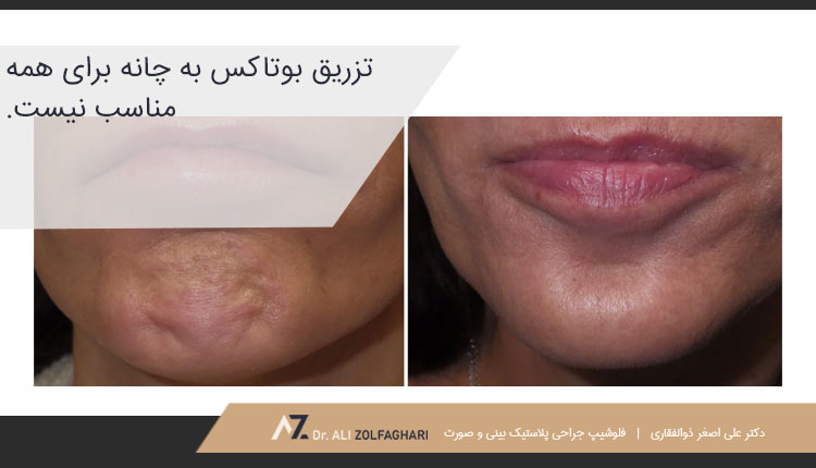 معایب تزریق بوتاکس به چانه