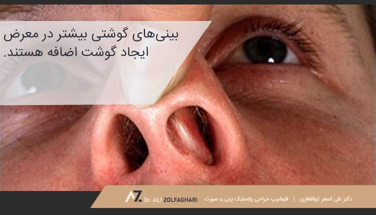 احتمال ایجاد گوشت اضافه در کدام بینی‌ها بیشتر است؟