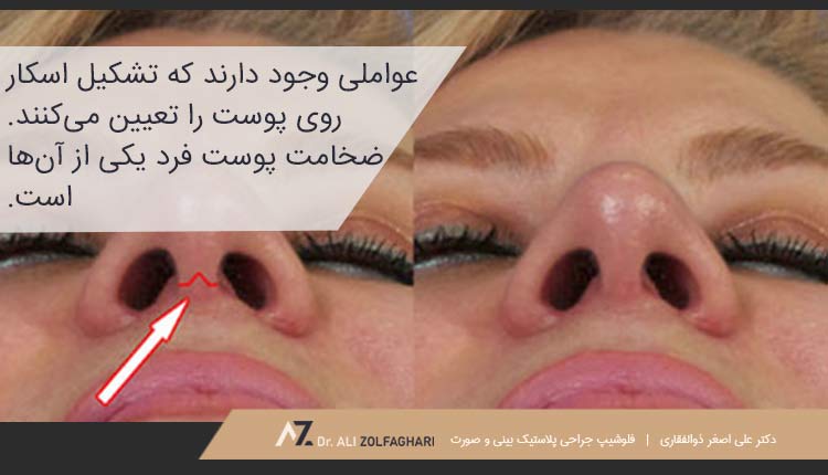 چرا گوشت اضافه بعد از عمل بینی ایجاد می‌شود؟