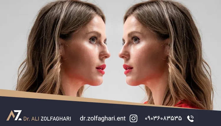 عمل بینی فانتزی سربالا برای بینی‌های گوشتی 