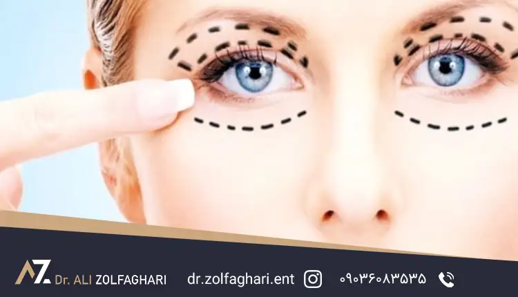مراقبت های بعد از عمل بلفاروپلاستی (جراحی پلک)