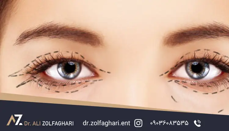 علائم هشدار دهنده در دوره نقاهت عمل بلفاروپلاستی