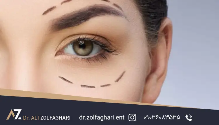 مدت زمان بهبودی بعد از بلفاروپلاستی