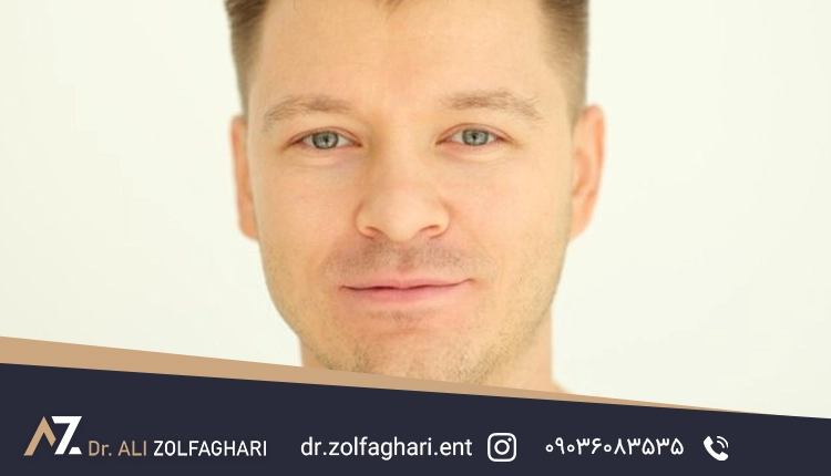 جراحی بینی گوشتی آقایان