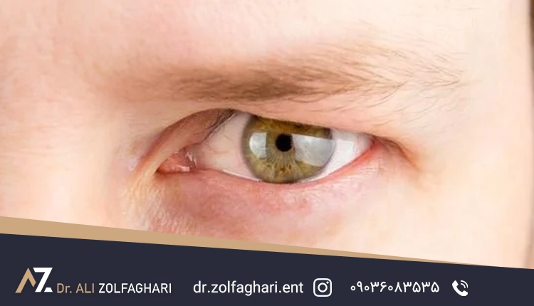 افتادگی پلک چیست؟