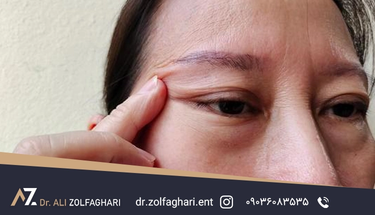 عوامل موثر برهزینه عمل بلفاروپلاستی
