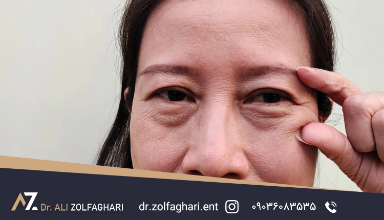 مرحله کلیدی در درمان افتادگی پلک