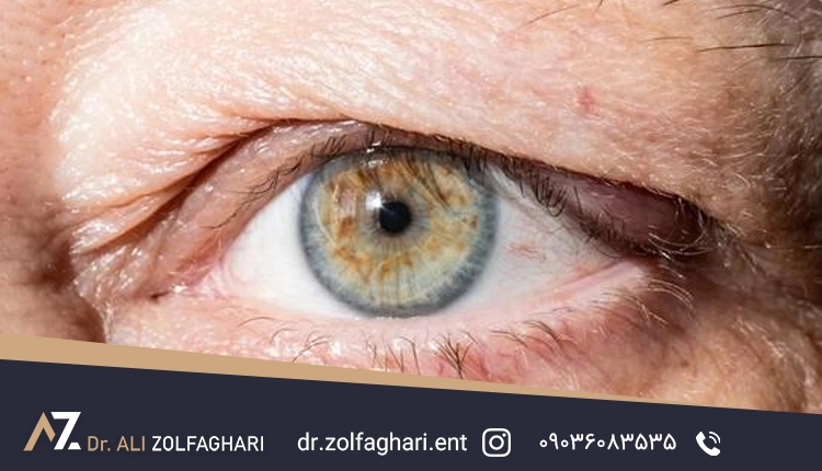 ورم بینی بعد از عمل بلفاروپلاستی