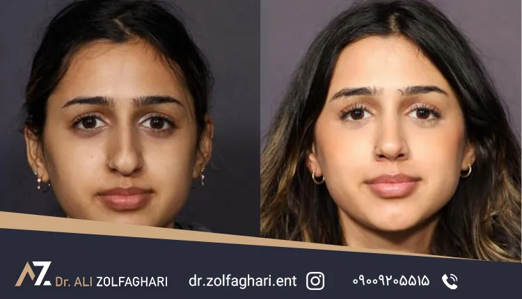 اصلاح فرم بینی در کنار درمان انحراف