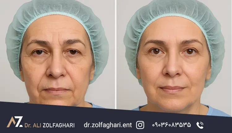 کاربرد لیفت اندوسکوپیک در نواحی مختلف صورت