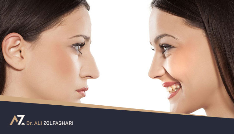 مدل جراحی بینی متناسب با چهره | عوامل موثر بر این موضوع