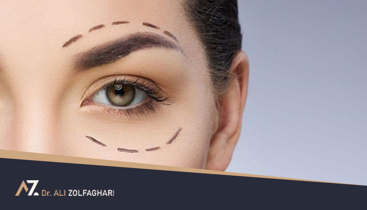عدم تقارن پلک بعد از عمل | علل عدم تقارن پلک بعد از عمل چیست؟