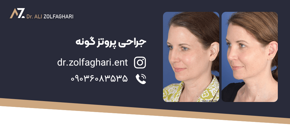 اقدامات قبل از جراحی پروتز گونه