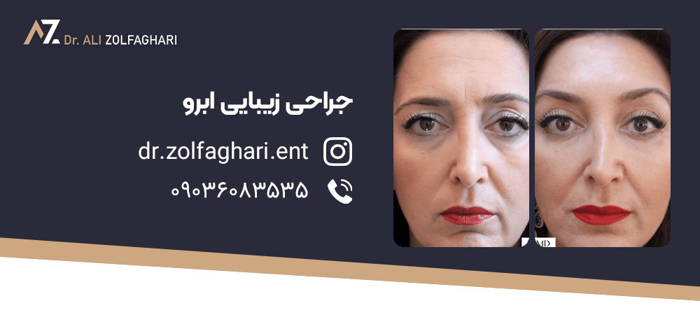 لیفت ابرو قبل و بعد