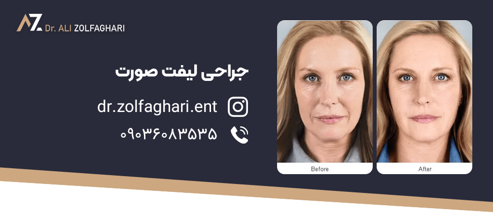 نکات مهم کاهش عوارض لیفتینگ صورت