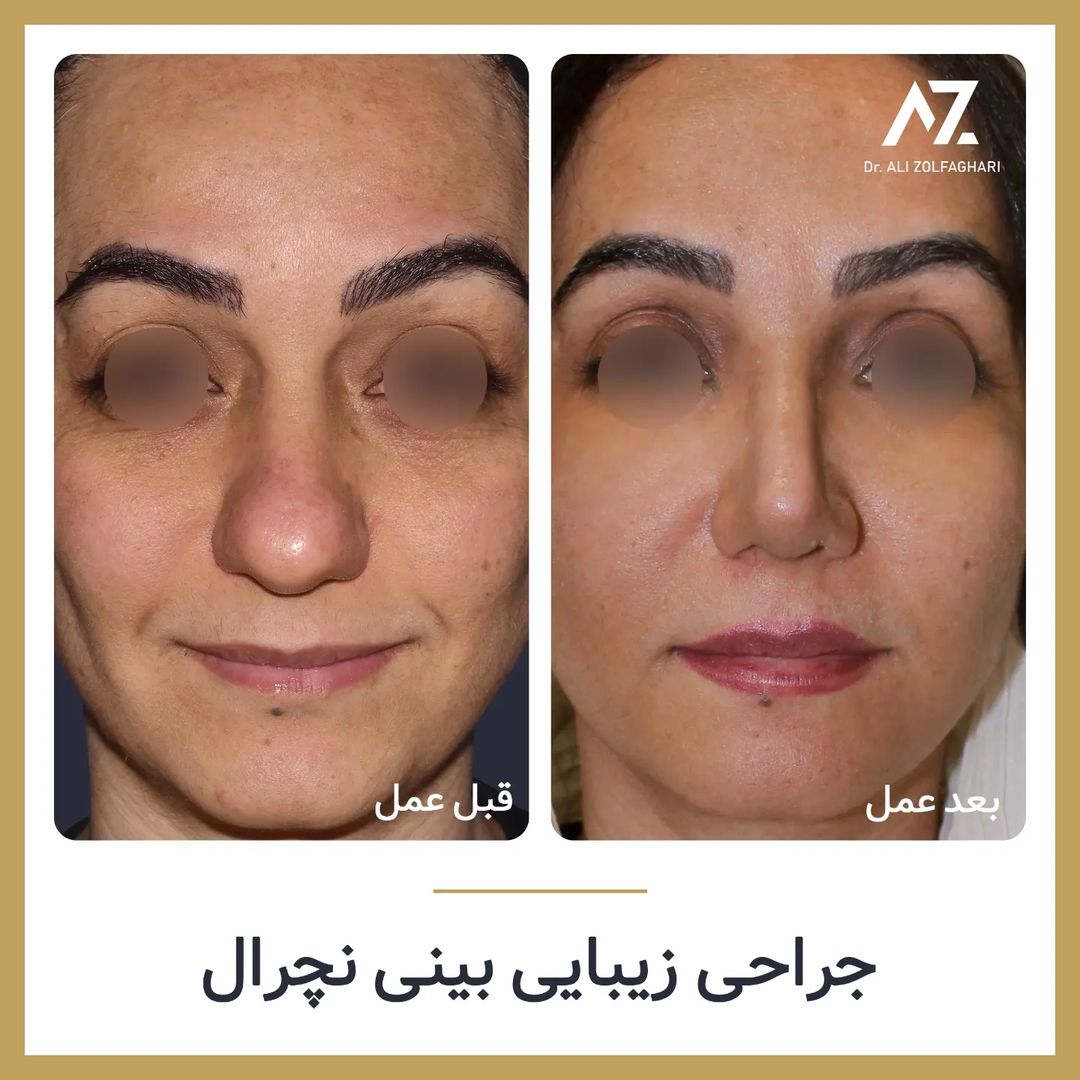 عکس قبل و بعد جراحی زیبایی بینی در تهران