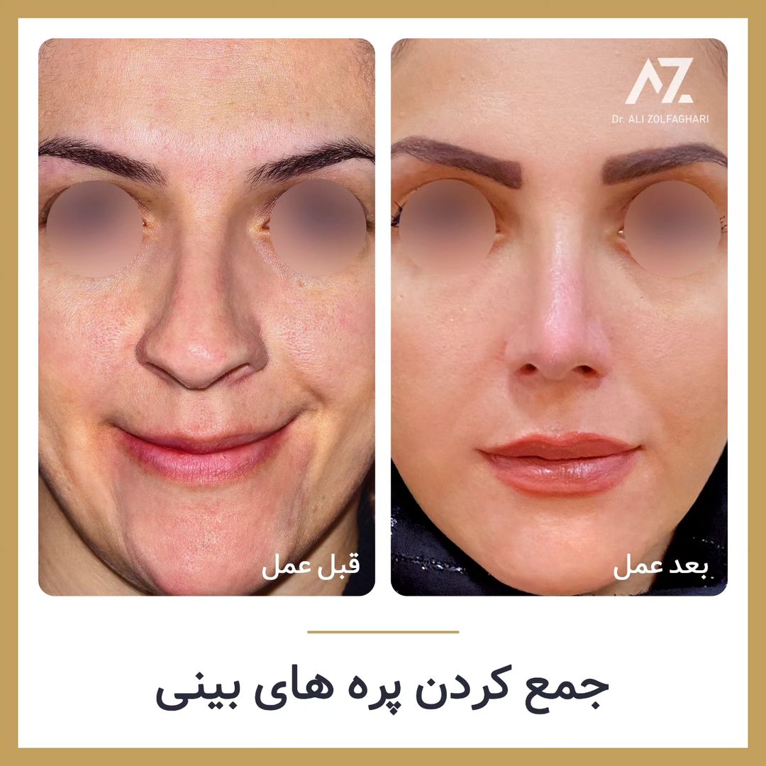 عکس قبل و بعد جراحی زیبایی بینی در تهران
