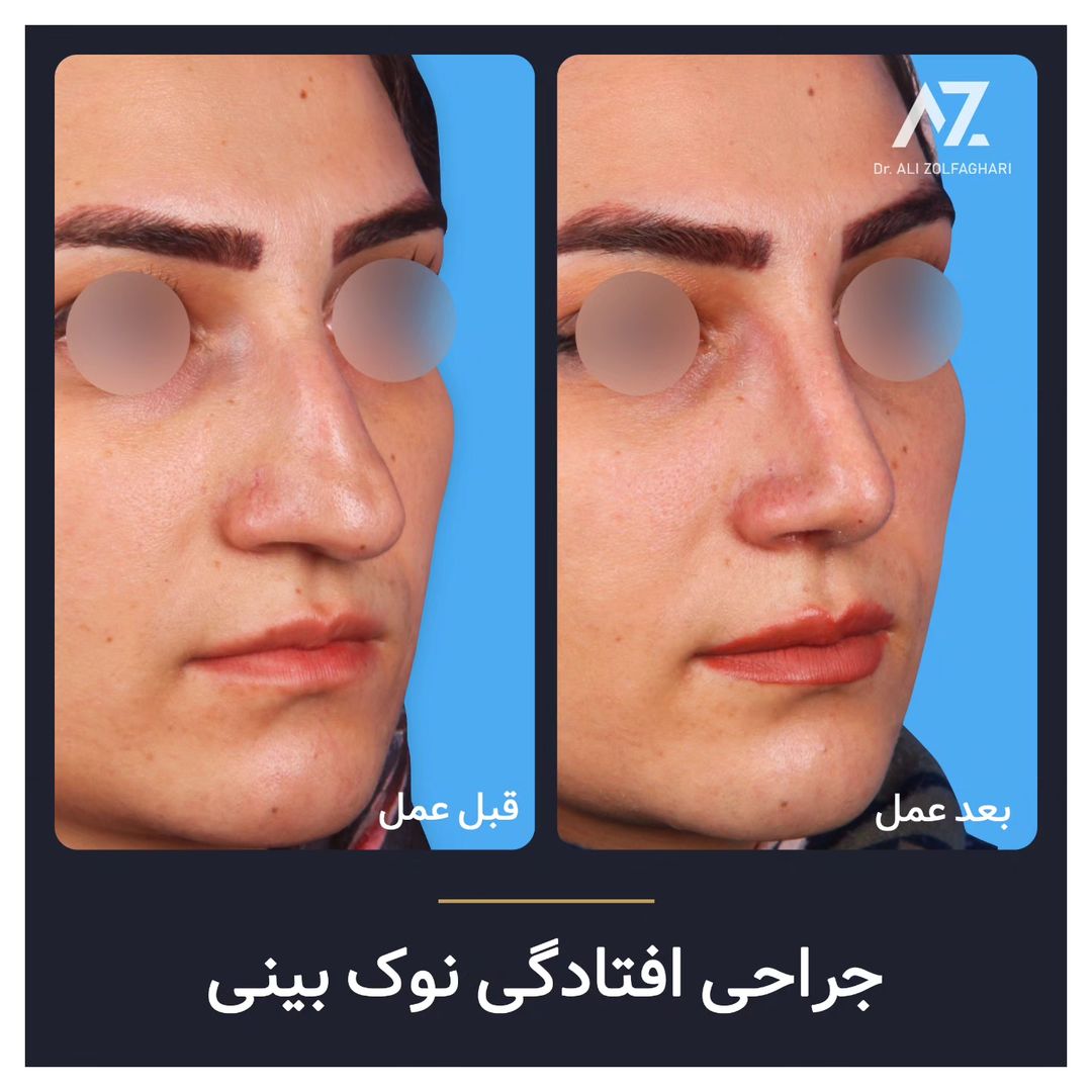 عکس قبل و بعد جراحی زیبایی بینی در تهران
