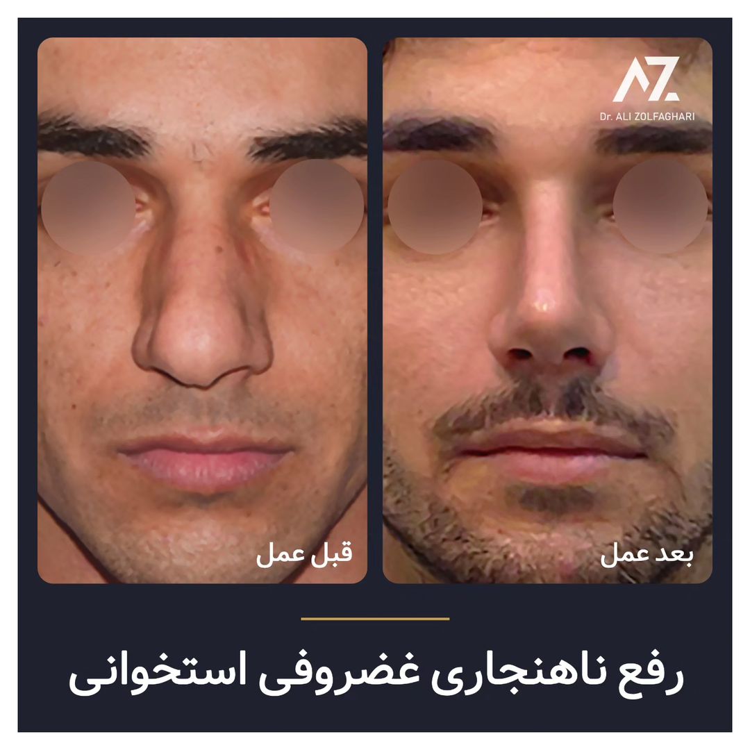 عکس قبل و بعد جراحی زیبایی بینی در تهران