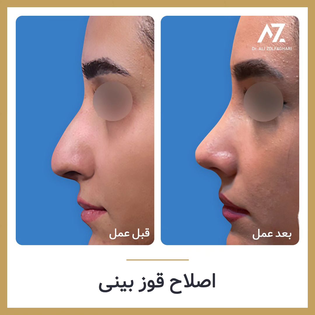عکس قبل و بعد جراحی زیبایی بینی در تهران