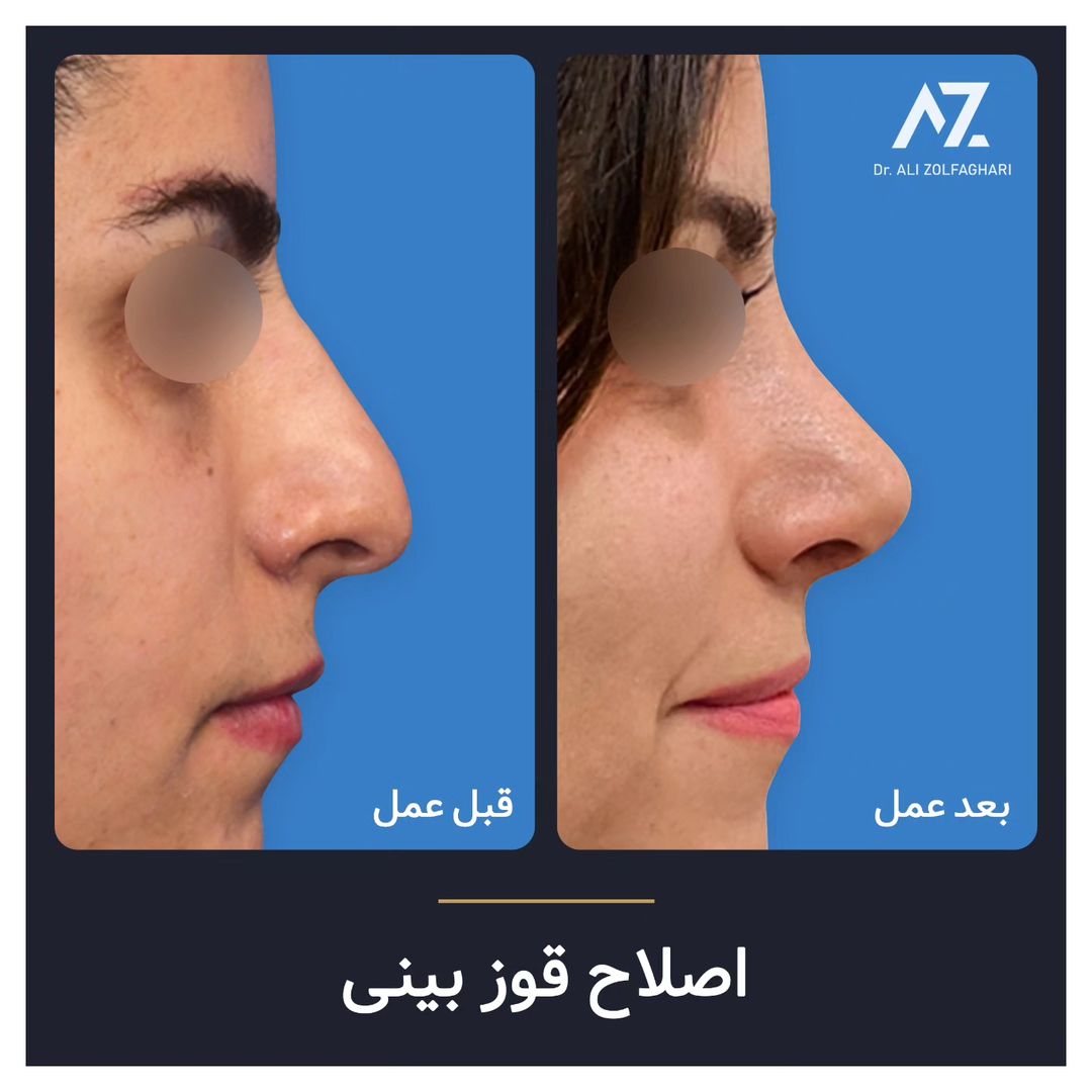 عکس قبل و بعد جراحی زیبایی بینی در تهران