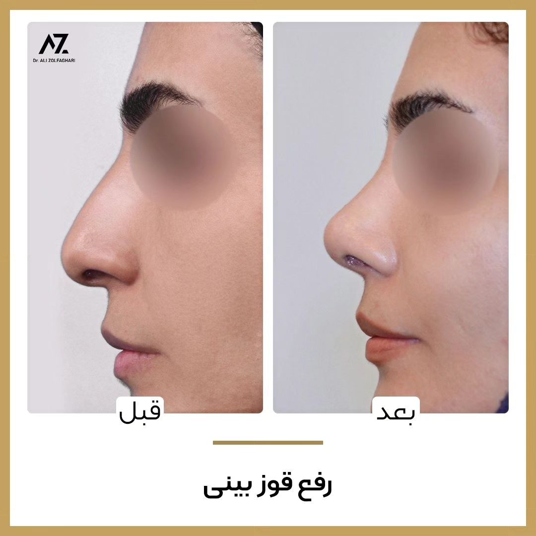 عکس قبل و بعد جراحی زیبایی بینی در تهران