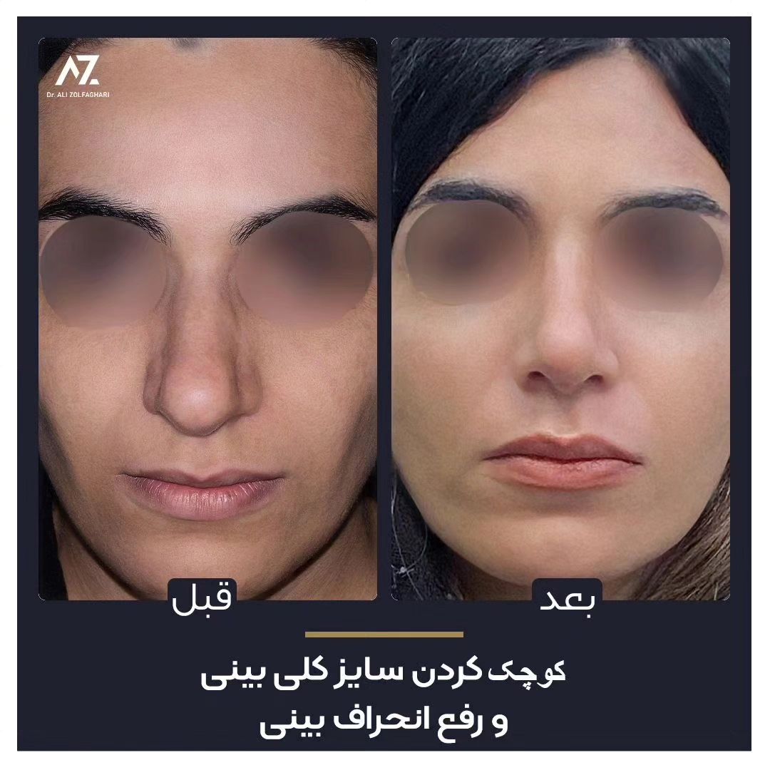 عکس قبل و بعد جراحی زیبایی بینی در تهران