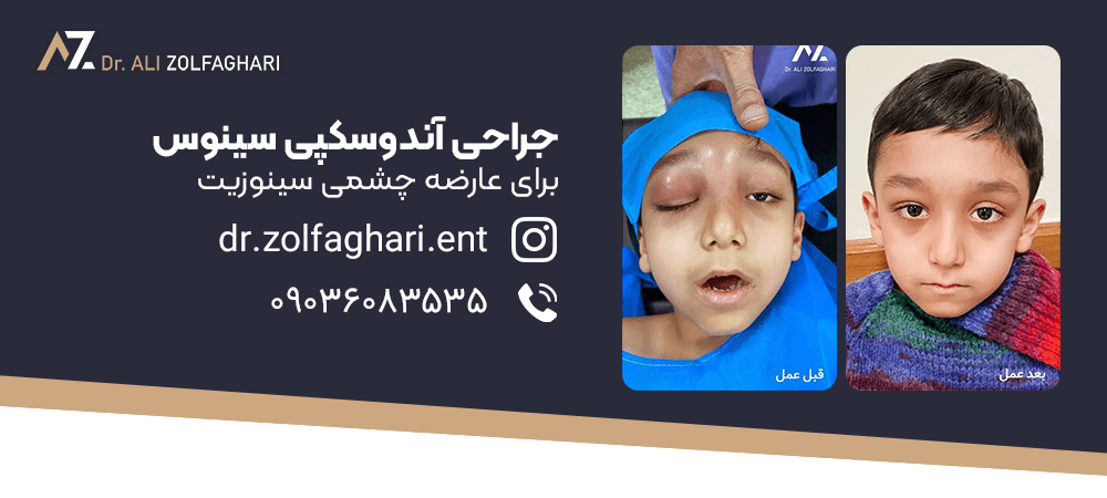کاربرد جراحی آندوسکوپی بینی و سینوس
