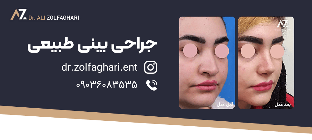 عکس قبل و بعد جراحی زیبایی بینی در تهران