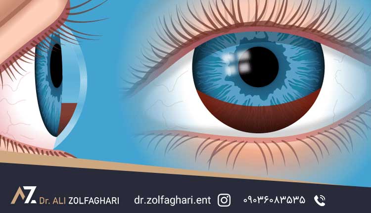 دلیل خون ریزی داخلی جشم بعد از جراحی بینی