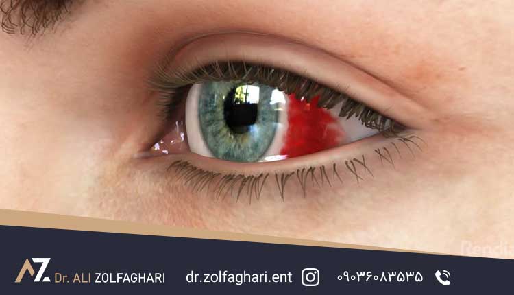 دلیل خون ریزی داخلی جشم بعد از جراحی بینی
