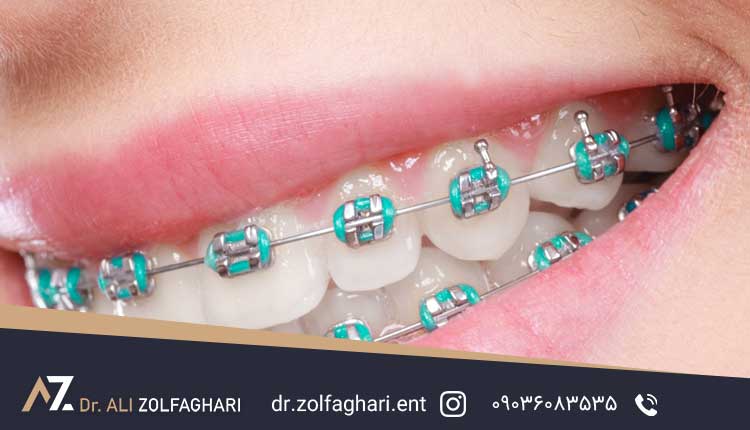آیا میتوان جراحی زیبایی بینی و ارتودنسی را همزمان انجام داد؟