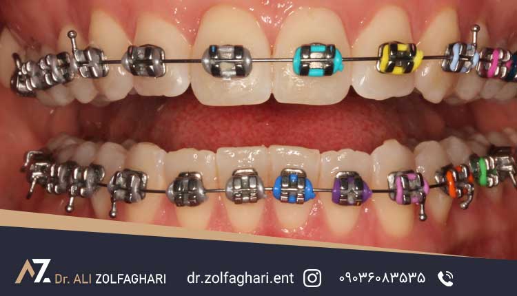 آیا میتوان جراحی زیبایی بینی و ارتودنسی را همزمان انجام داد؟