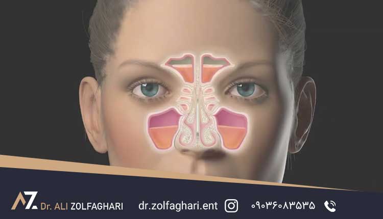 بهترین غذاها برای مشکلات سینوسی