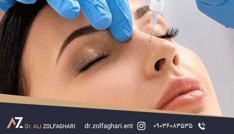 بینی منگنه ای یا کلیپسی