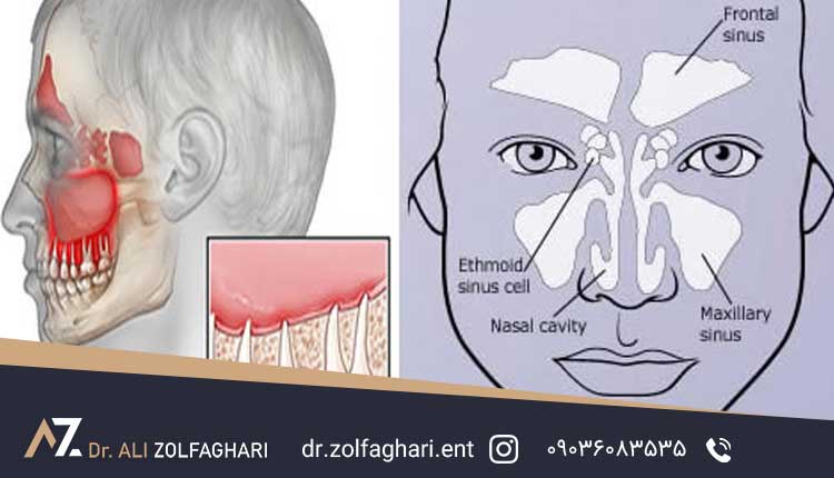 رابطه درد دندان و عفونت سینوس