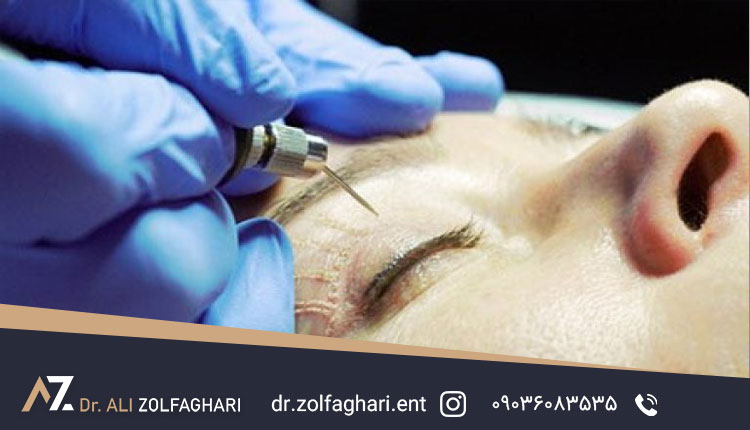 استفاده از لیزر برای حذف جای بخیه بعد از بلفاروپلاستی