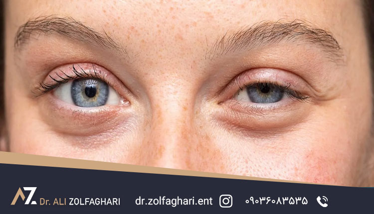 قرینه نبودن چشم‌ ها بعد از جراحی پلک ممکن است؟